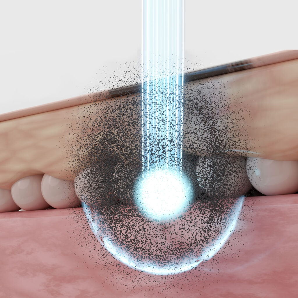 ピコレーザーのイメージ