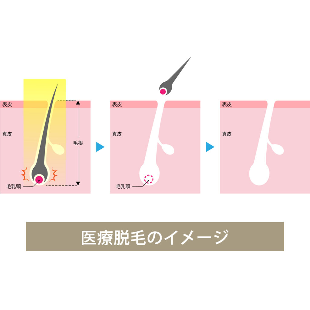 医療脱毛の仕組みイメージ