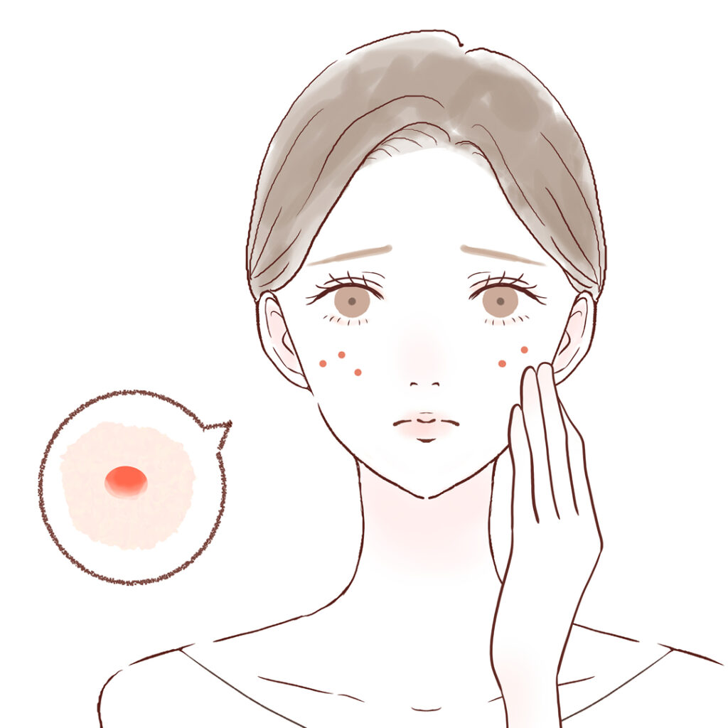 福岡でニキビでなやんでいる女性のイメージのイラスト