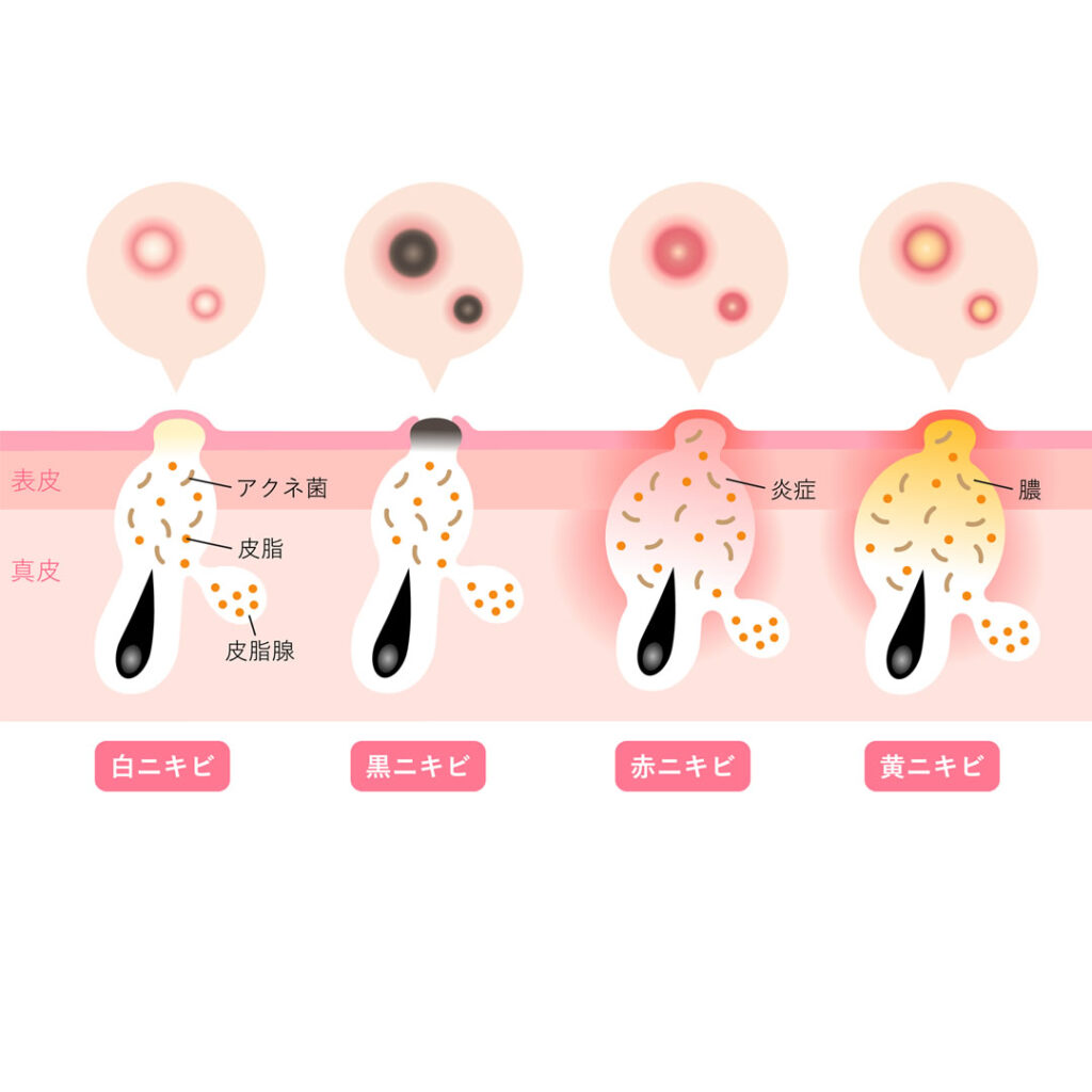 ニキビの種類