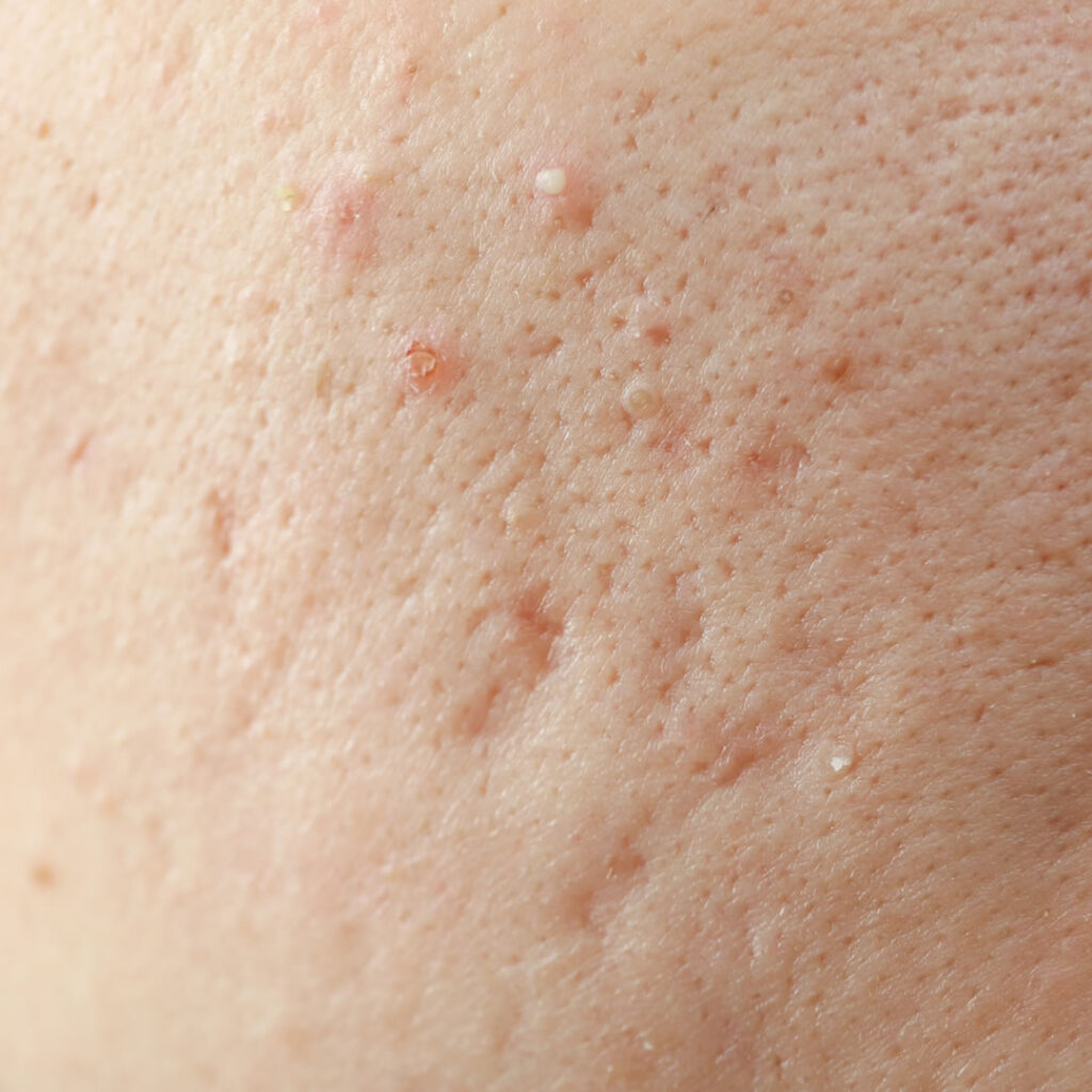 ニキビ跡のクレーター