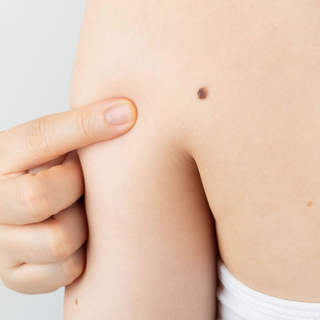 背中にあるホクロ