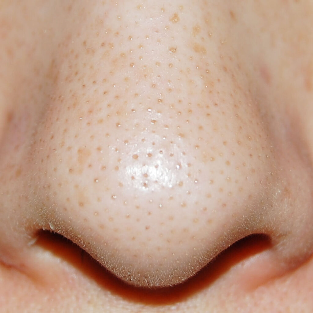 黒ずんでいる毛穴の状態