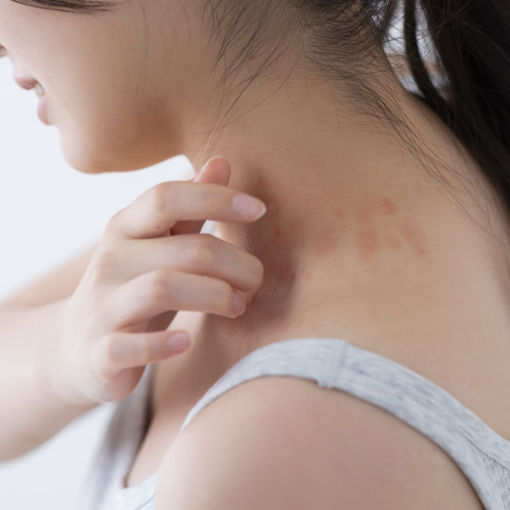 アトピーに悩む女性