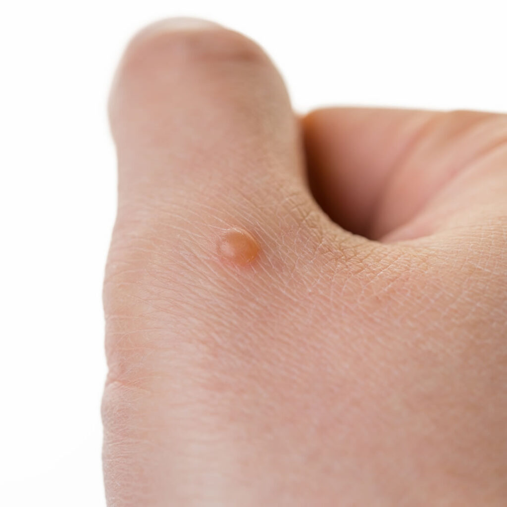 水いぼに悩む女性