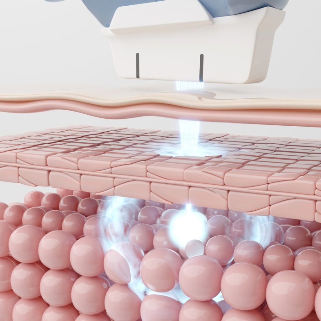 ハイフのイメージ